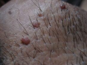 Papilloma de soldadura