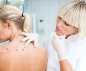 Síntomas do virus do papiloma humano