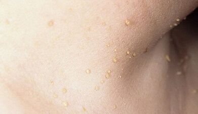 Risco de papilomatose do pescozo