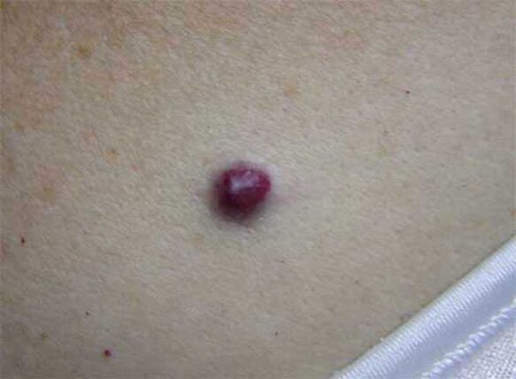 Marca de nacemento vermella no corpo
