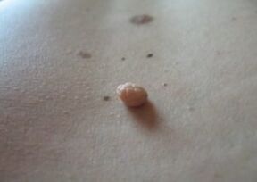 Un papiloma é un crecemento na superficie da pel