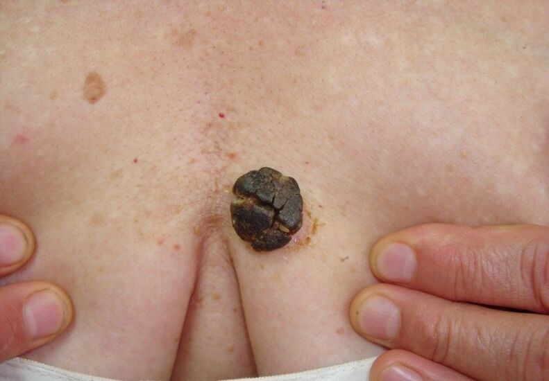 Queratoma no corpo humano