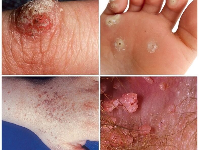 Tipos de verrugas no corpo humano