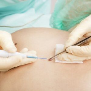 Extirpación do papiloma por un cirurxián